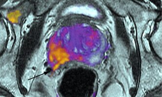 prostat-kanser-780x470.jpg