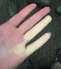 Raynaud_syndrome_on_female_airman's_hand.jpg